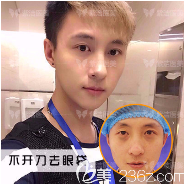 北京紫洁医美不开刀祛眼袋案例