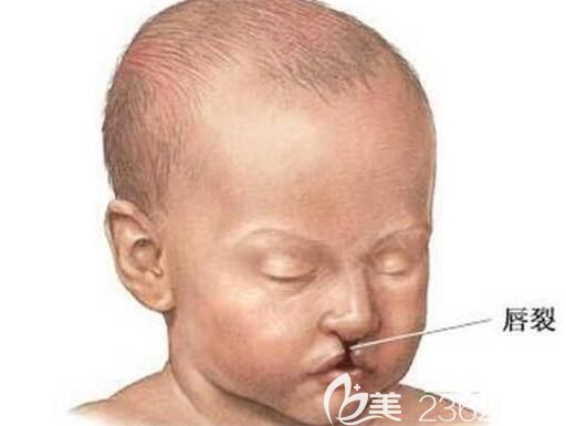 唇腭裂又叫“兔唇”