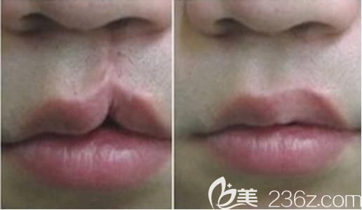 唇腭裂修复效果