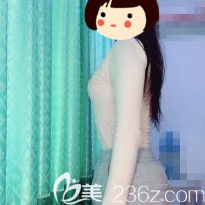 在长沙yestar做手臂吸脂术后20天效果