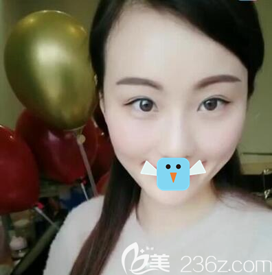 成都悦好胡纯兵全脸脂肪填充术后效果图 成都悦好胡纯兵全脸脂肪填充术后效果图