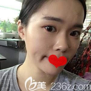 在邯郸雅丽注射瘦脸术后一周脸型有变化