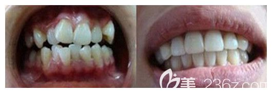 昆明德韩口腔牙齿矫正案例
