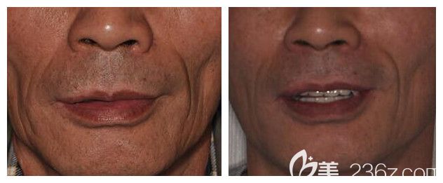 昆明德韩口腔全口种植牙案例