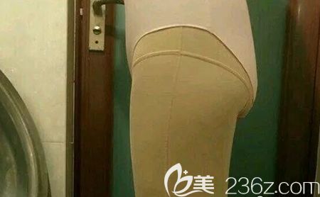 找赣州韩美美容医院何斌做大腿吸脂术后第4天 找赣州韩美美容医院何斌做大腿吸脂术后第4天