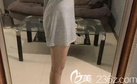 找赣州韩美美容医院何斌做大腿吸脂术后第16天 找赣州韩美美容医院何斌做大腿吸脂术后第16天