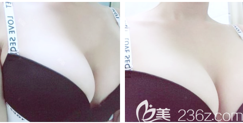 深圳丽港丽格做隆胸效果怎么样 深圳丽港丽格做隆胸效果怎么样
