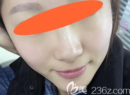 在宜春天泽整形医院找周玲主任做激光祛斑后仅仅20天脸上干净多了