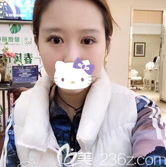 找刘志刚做双眼皮修复术前照 找刘志刚做双眼皮修复术前照