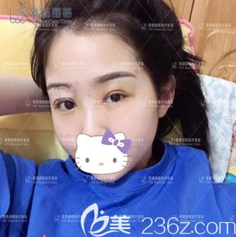 在大连爱德丽格做双眼皮修复术后1天 在大连爱德丽格做双眼皮修复术后1天