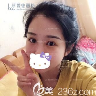 找爱德丽格刘志刚做双眼皮修复术后5天效果 找爱德丽格刘志刚做双眼皮修复术后5天效果