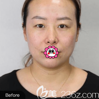 我在北京惠合嘉美做眼综合前样子 我在北京惠合嘉美做眼综合前样子