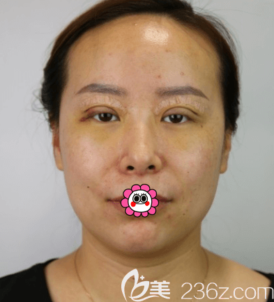 <!--<i data=20240703-sp></i>-->医生给我做眼综合第3天样子 <!--<i data=20240703-sp></i>-->医生给我做眼综合第3天样子