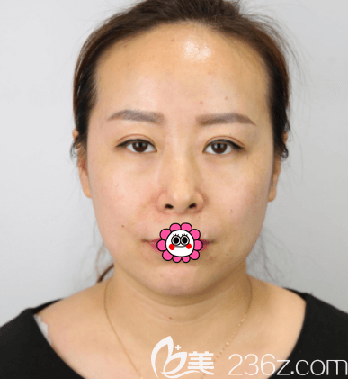 在北京惠合嘉美做眼综合第26天样子 在北京惠合嘉美做眼综合第26天样子