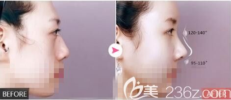 假体隆鼻(硅胶、膨体)