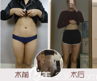 <i data-id='83af8841-c035-4b8e-8258-ec859ca8c7c0' ></li>
<li><i data=20240703-sp></i>-->腿吸脂案例 <i data-id='83af8841-c035-4b8e-8258-ec859ca8c7c0' style='display:none;'></i>妇婴医院-整形<!--<i data=20240703-sp></i>-->腿吸脂案例