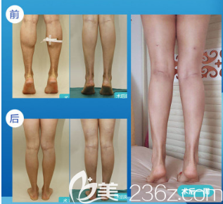 德州天宏医疗美容大腿吸脂案例 德州天宏医疗美容大腿吸脂案例