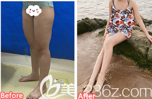 德州市友谊医疗美容诊所大腿吸脂案例 德州市友谊医疗美容诊所大腿吸脂案例
