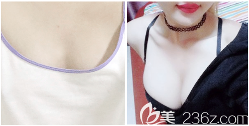 深圳丽港丽格谢俊隆胸案例前后对比图 深圳丽港丽格谢俊隆胸案例前后对比图