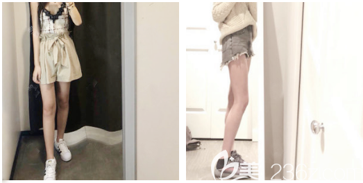 佛山抽脂哪家好?看佛山梦露大腿吸脂案例 佛山抽脂哪家好?看佛山梦露大腿吸脂案例