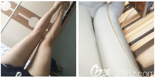 大腿吸脂术后7天恢复过程图 大腿吸脂术后7天恢复过程图