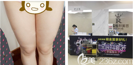 在佛山梦露做大腿吸脂术前照片 在佛山梦露做大腿吸脂术前照片