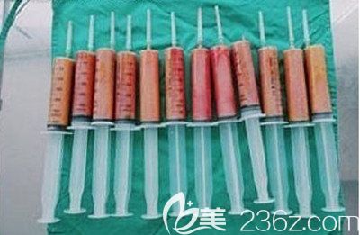 韩国安敬天吸脂真人案例 韩国安敬天吸脂真人案例