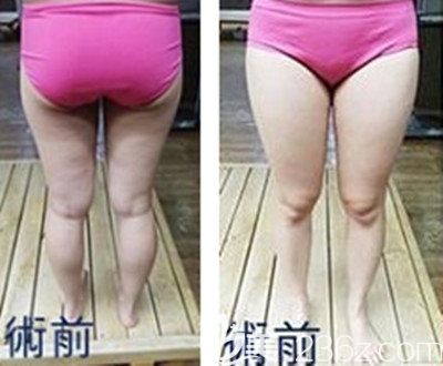 韩国纯真整形医院安敬天大腿吸脂真人案例 韩国纯真整形医院安敬天大腿吸脂真人案例