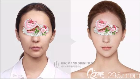 长春姬安娣整形全面部自体脂肪填充案例效果图 长春姬安娣整形全面部自体脂肪填充案例效果图