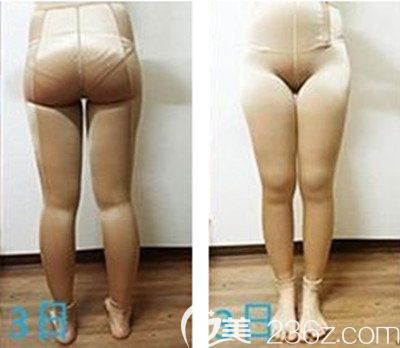 韩国纯真安敬天腿部吸脂术后3天恢复效果 韩国纯真安敬天腿部吸脂术后3天恢复效果