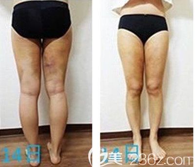 韩国安敬天大腿吸脂案例术后2周恢复效果图