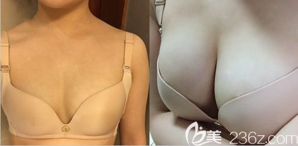 长春姬安娣整形自体脂肪丰胸案例效果图 长春姬安娣整形自体脂肪丰胸案例效果图