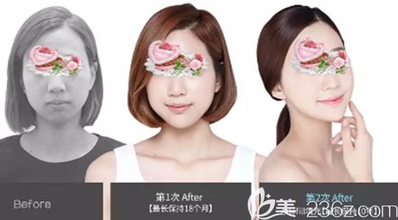 长春姬安娣整形面部轮廓注射塑形案例效果图 长春姬安娣整形面部轮廓注射塑形案例效果图