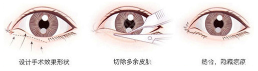 深圳希思李瑞芳医生双眼皮手术过程图