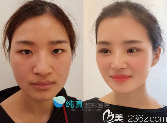 韩国线真崔宰源院长3D螺旋V脸提升术案例前后效果对比图