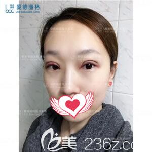 找冯勇做双眼皮开眼角术后1天效果 找冯勇做双眼皮开眼角术后1天效果
