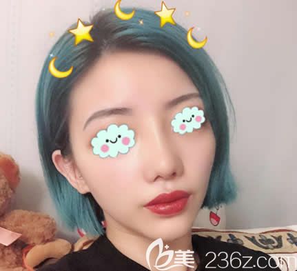 台州艺星王波隆鼻失败修复案例