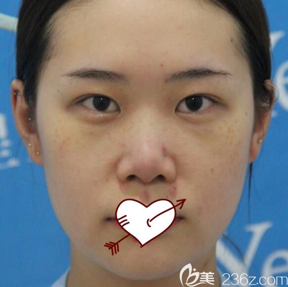 找耿继龙做肋软骨鼻综合前样子 找耿继龙做肋软骨鼻综合前样子