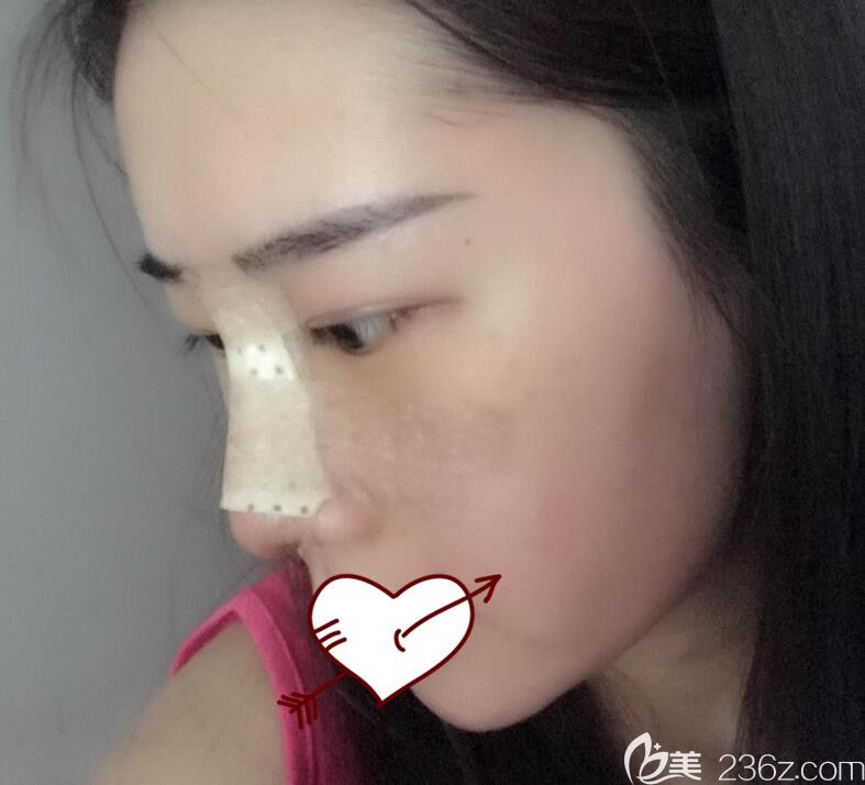 合肥艺星整形软骨隆鼻第3天图 合肥艺星整形软骨隆鼻第3天图