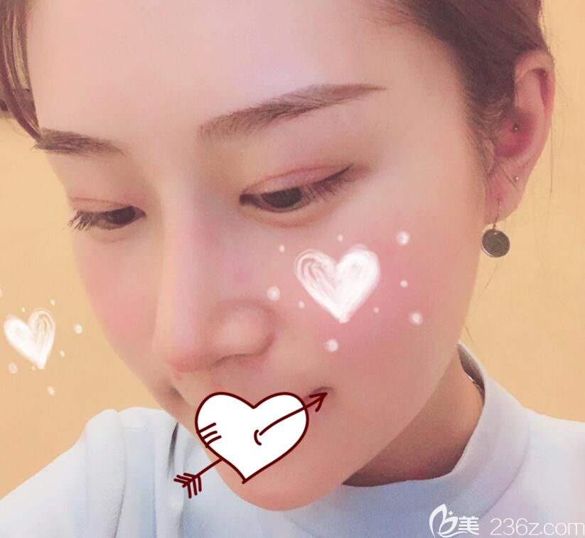 艺星整形肋软骨隆鼻术后13天恢复情况 艺星整形肋软骨隆鼻术后13天恢复情况