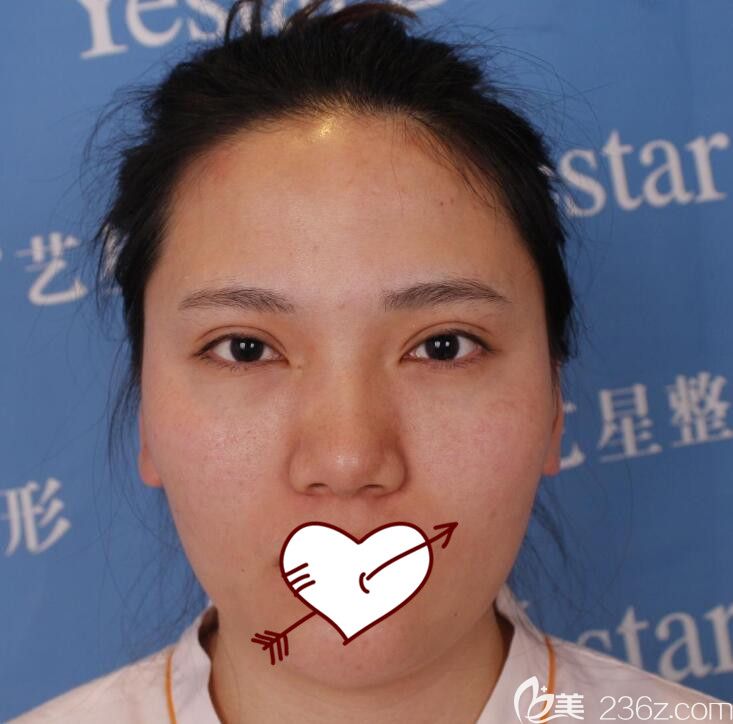 找合肥艺星整形孙洋做自体脂肪填充全脸前 找合肥艺星整形孙洋做自体脂肪填充全脸前