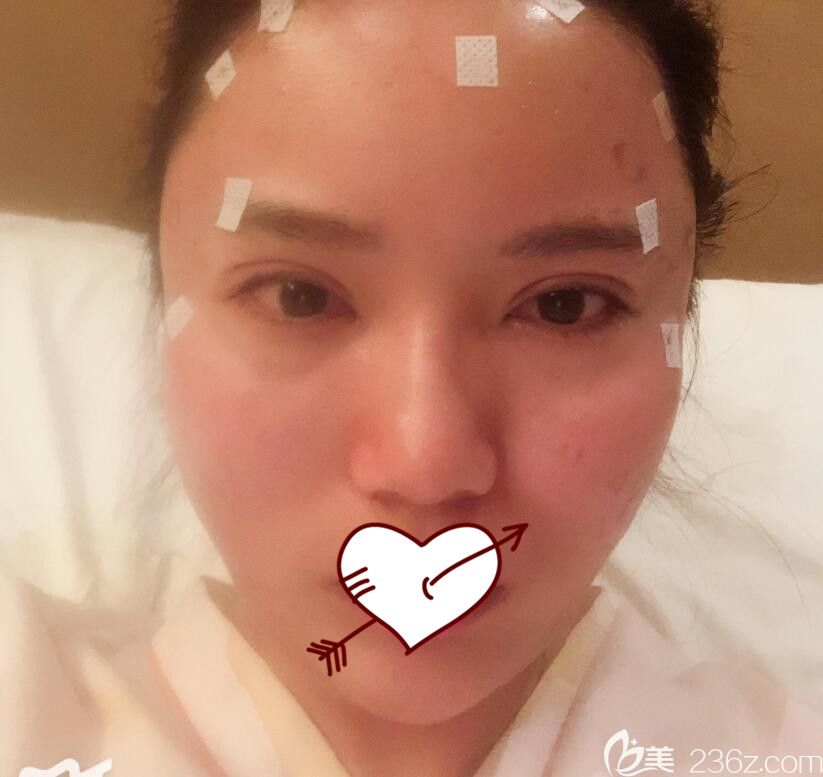 孙洋做自体脂肪全脸填充术后第2天情况 孙洋做自体脂肪全脸填充术后第2天情况