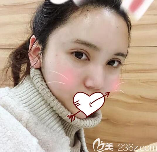 合肥艺星整形自体脂肪填充全脸术后第4天恢复图 合肥艺星整形自体脂肪填充全脸术后第4天恢复图