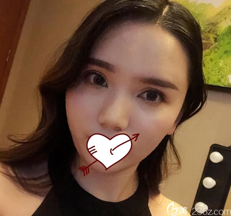 自体脂肪填充术后23天 自体脂肪填充术后23天