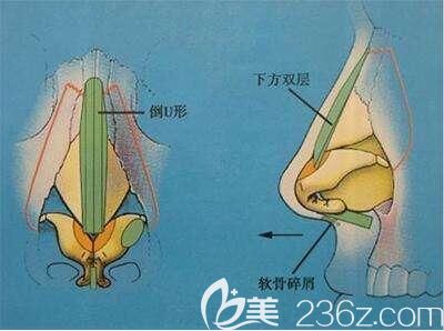 上海丽质医疗美容全肋软骨和半肋软骨鼻综合不同