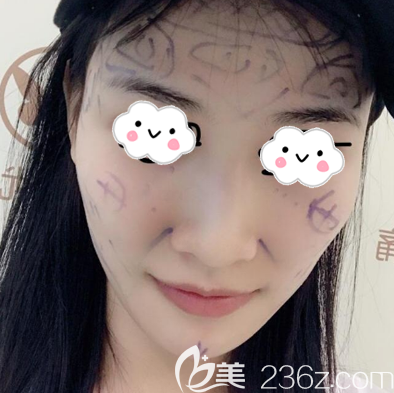 在深圳非凡做脂肪填充术前照片 在深圳非凡做脂肪填充术前照片