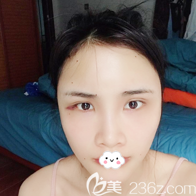 全脸自体脂肪填充术后4天恢复图片 全脸自体脂肪填充术后4天恢复图片