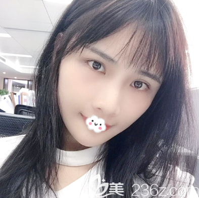 看深圳非凡全脸脂肪填充案例术后15天效果怎么样 看深圳非凡全脸脂肪填充案例术后15天效果怎么样