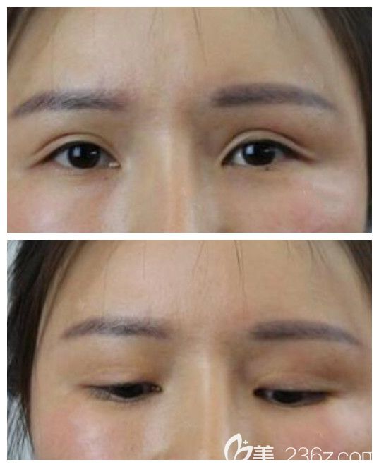 全切双眼皮失败后图片,双眼皮太宽,眼部疤痕明显 全切双眼皮失败后图片,双眼皮太宽,眼部疤痕明显