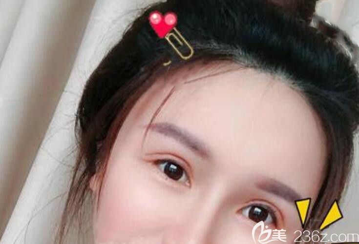 找合肥艺星整形孙洋做眼部修复第8天拆线后照片 找合肥艺星整形孙洋做眼部修复第8天拆线后照片